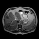Liver metastasis of adenocarcinoma of colon, colorectal carcinoma, biopsy: MRI - Magnetic Resonance Imaging